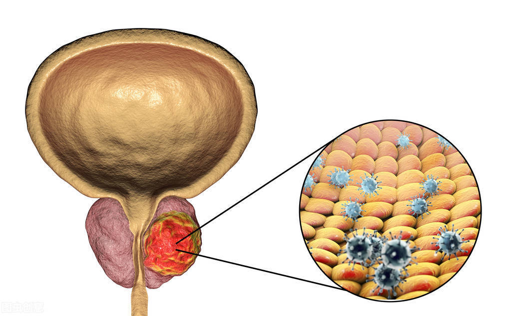 前列腺癌症状.jpeg